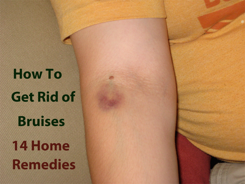 How To Get Rid Of Bruises Fast And Overnight 14 Home Healing Remedies