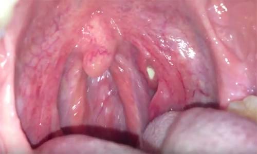 white patch on tonsil sore throat