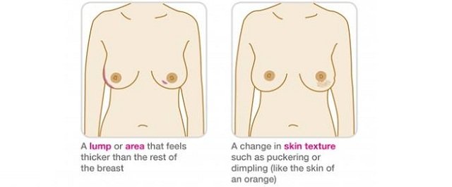 Breast Cancer Signs and Symptoms