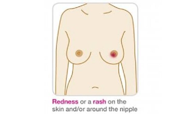 Breast Cancer Signs and Symptoms