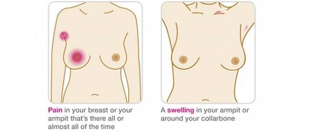 Breast Cancer Signs and Symptoms