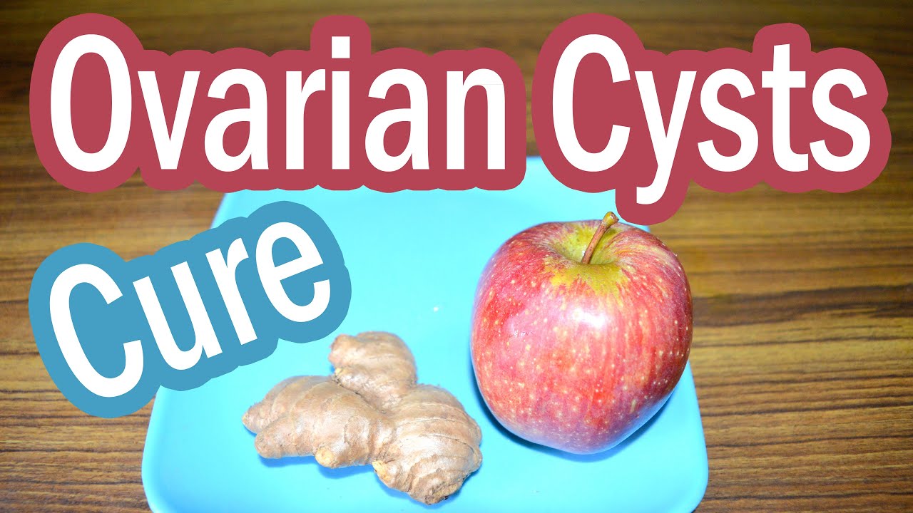 Natural remedies for ovarian cysts