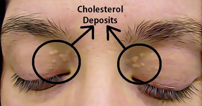 Remove the Cholesterol Deposits Around Your Eyes