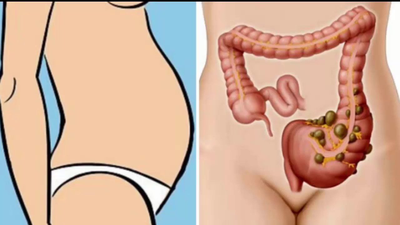 You Are Not Fat – You Have “Poo” Stuck In Your Body! Here Is How To Eliminate It Instantly