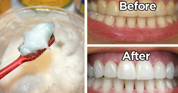 how can you use baking soda to whiten your teeth