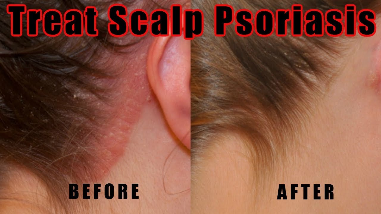 scalp psoriasis treatment natural
