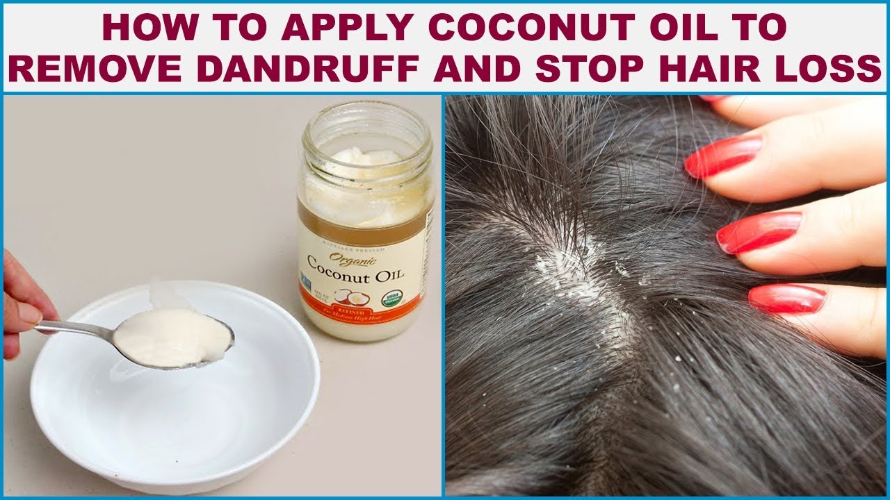Natural Remedies for Dandruff: Say Goodbye to Flaky Scalp