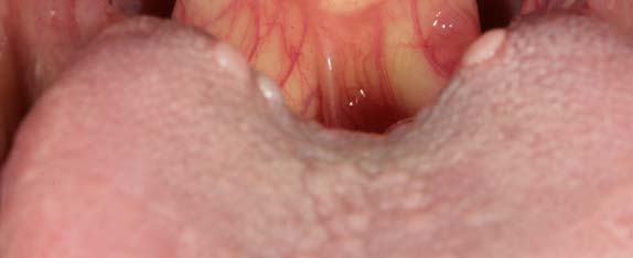 swollen taste buds back of tongue sore throat.