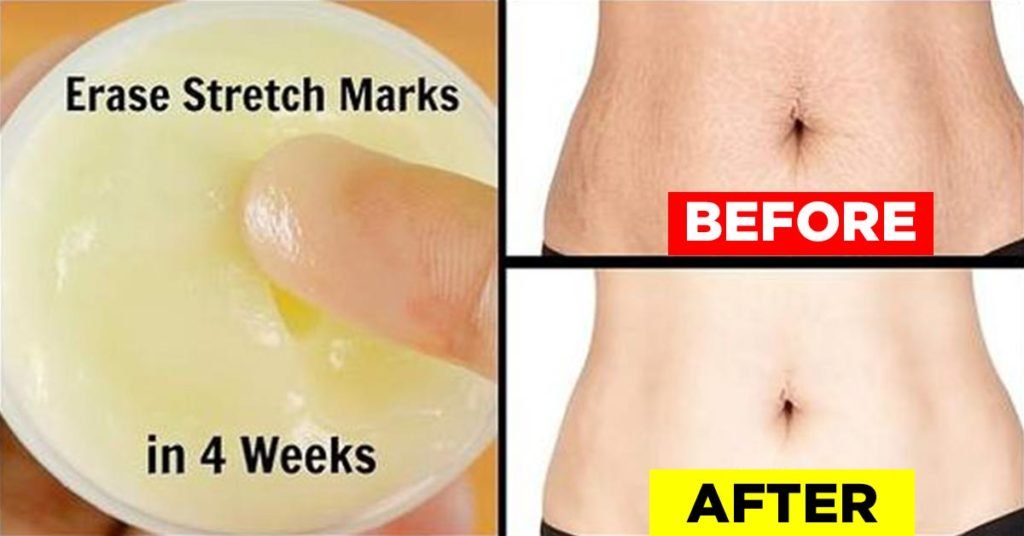 7 Simple Home Remedies for Stretch Marks