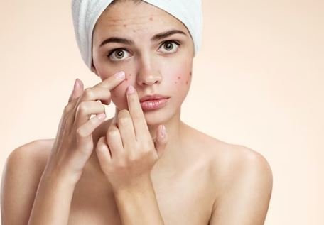 Get Rid of Acne Scars Naturally