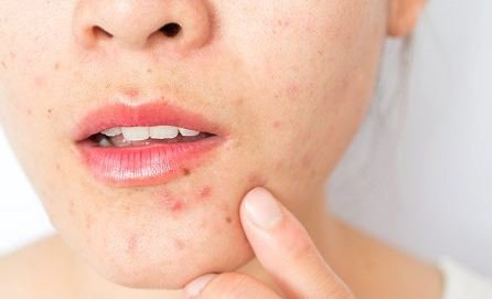 hormonal acne remedies